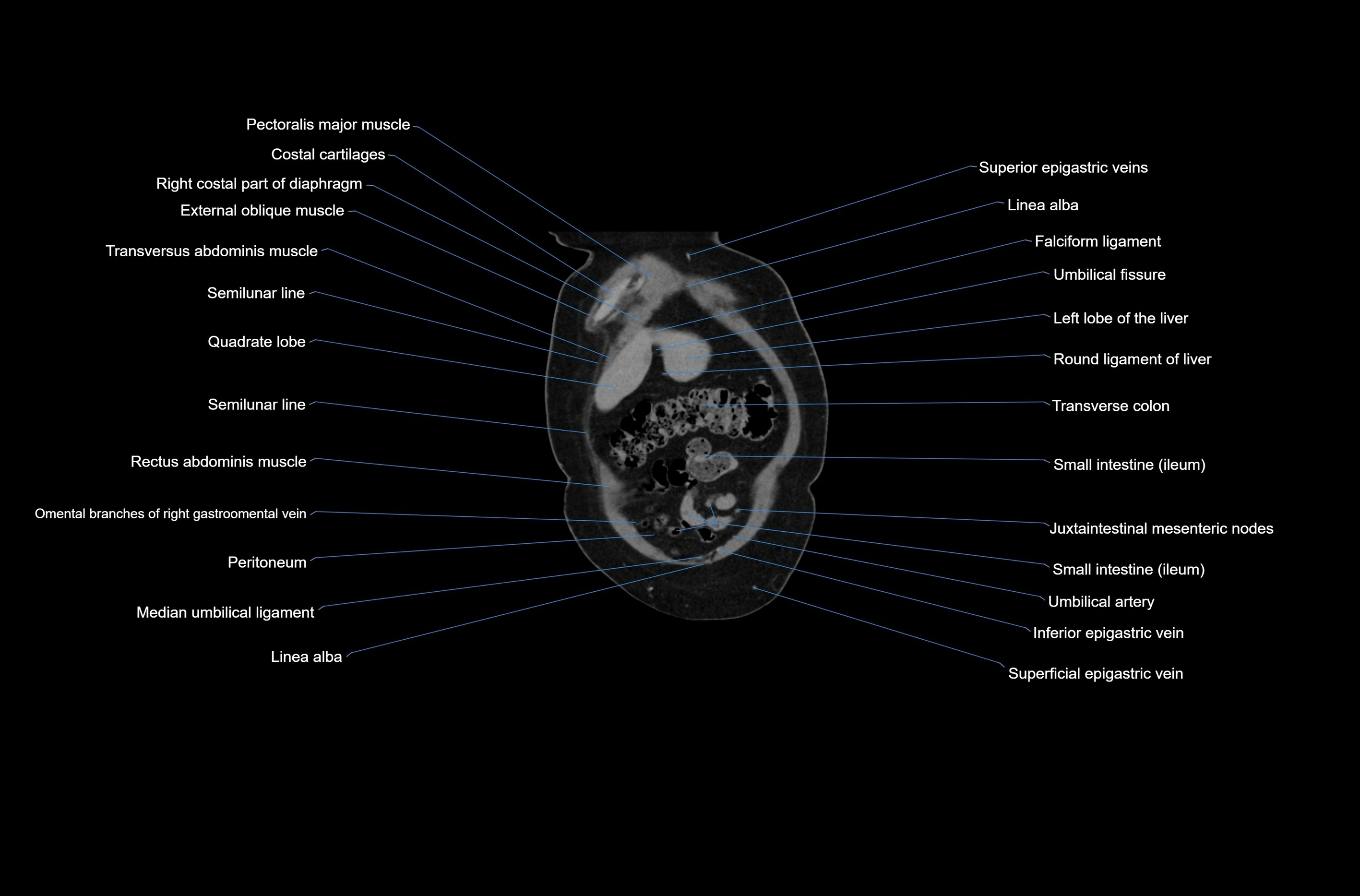 CT abdomen coronal cross sectional anatomy labelled radiology image-00011.webp